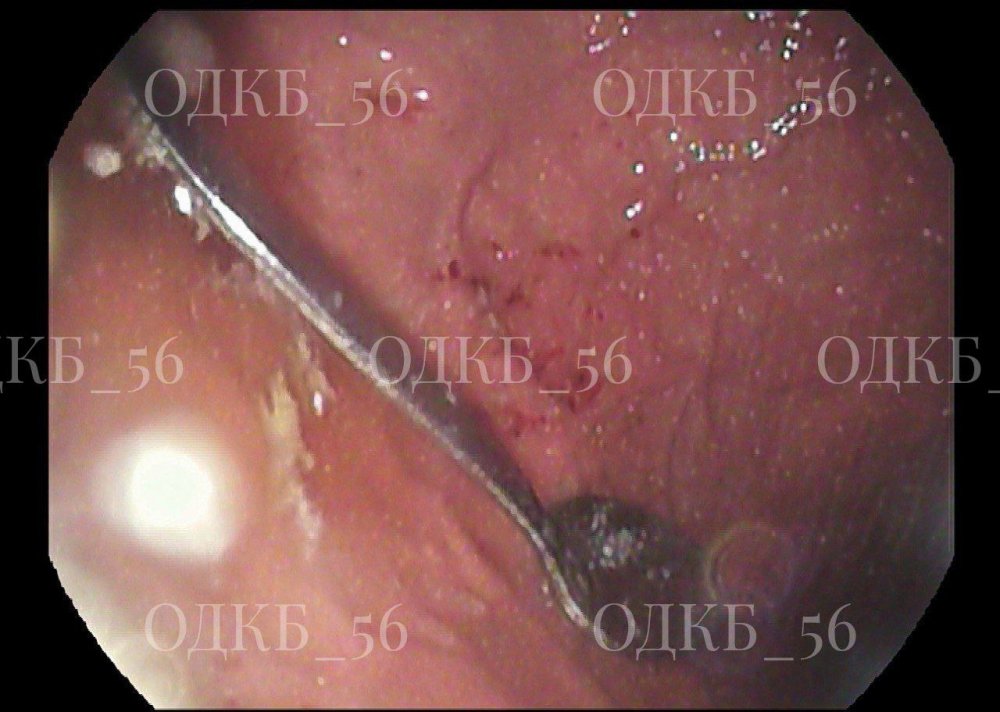 Металлическая ложка, которую проглотил ребёнок 