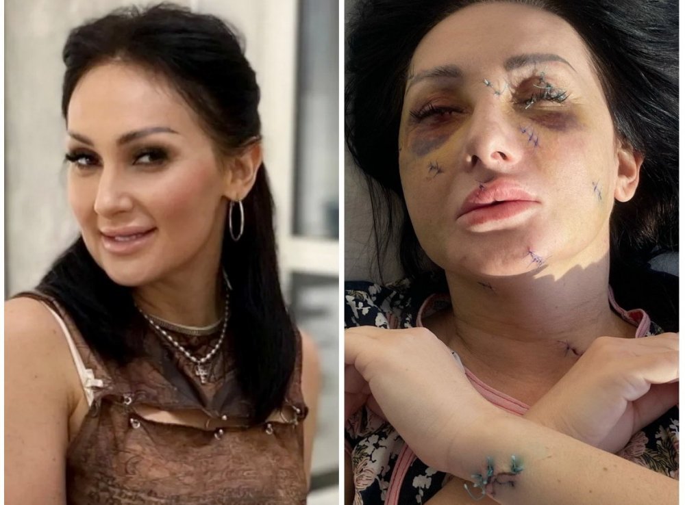 Алла Березовская до и после нападения ревнивца